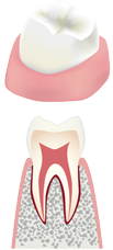 虫歯の初期状態