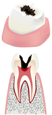 虫歯の後期状態(中期)